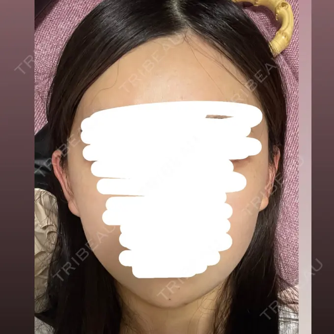 ボトックス（あご） / ヒアルロン酸注入（あご） 銀座TAクリニック AFTER メイン用