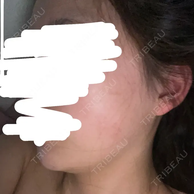 ハイフ（顔） DAILY SKIN CLINIC 新宿院 AFTER メイン用