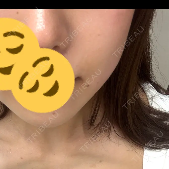 ハイフ（顔） 東京美容外科 池袋院 AFTER メイン用