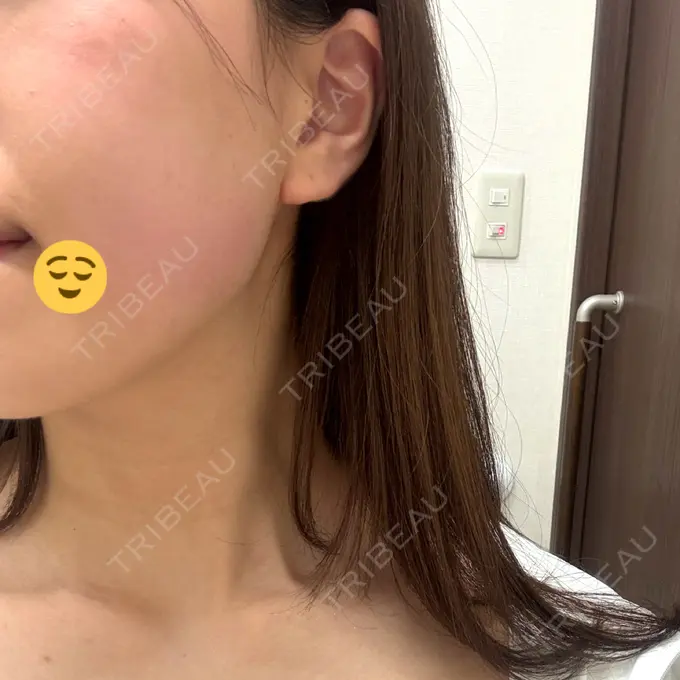 ハイフ（顔） 東京美容外科 池袋院 DAY 0 メイン用