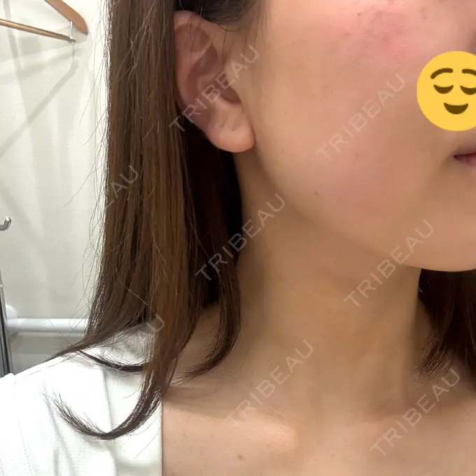 ハイフ（顔） 東京美容外科 池袋院 DAY 0 メイン用