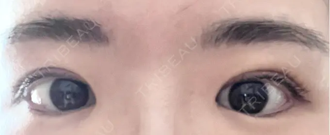 二重埋没 OMI CLINIC 【オミクリニック】 DAY 7 メイン用