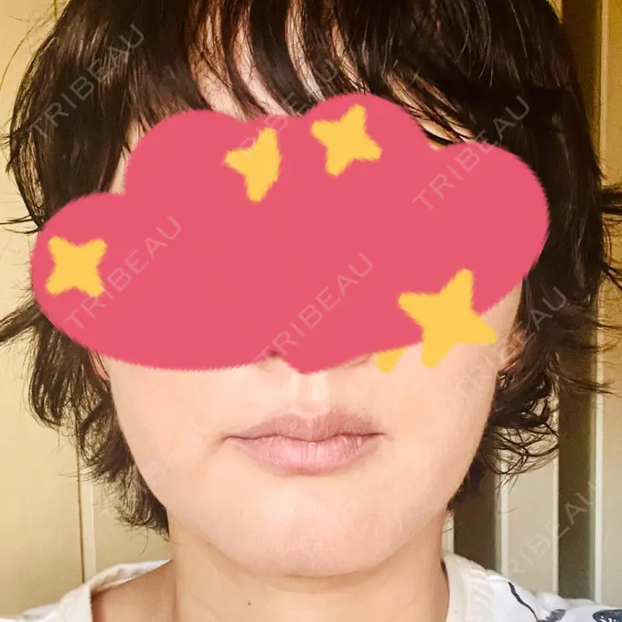 RF（高周波）たるみ治療 / その他（輪郭） DAILY SKIN CLINIC 心斎橋院 DAY 8 メイン用