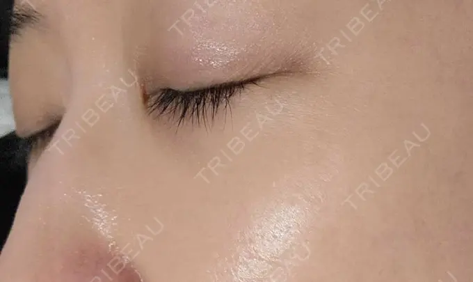 下まぶたの脂肪取り / 脂肪溶解注射（顔） 仙台N美容クリニック DAY 69 メイン用