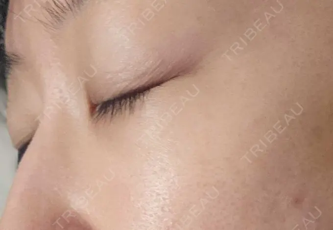 下まぶたの脂肪取り / 脂肪溶解注射（顔） 仙台N美容クリニック DAY 112 メイン用