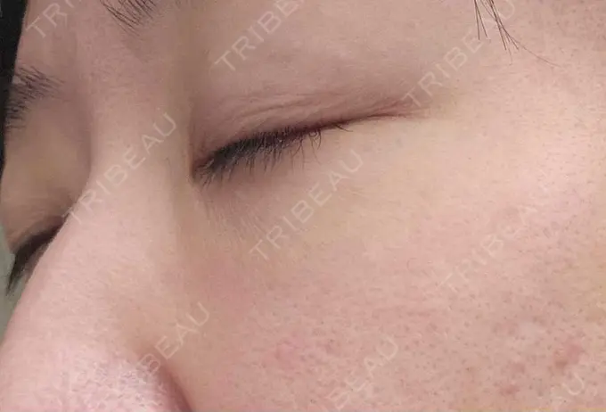 下まぶたの脂肪取り / 脂肪溶解注射（顔） 仙台N美容クリニック DAY 114 メイン用