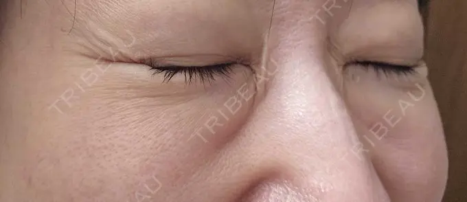 下まぶたの脂肪取り / 脂肪溶解注射（顔） 仙台N美容クリニック DAY 129 メイン用