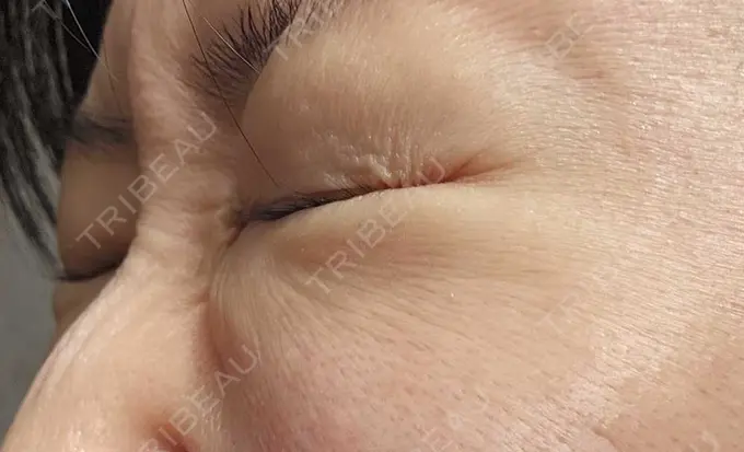 下まぶたの脂肪取り / 脂肪溶解注射（顔） 仙台N美容クリニック DAY 132 メイン用