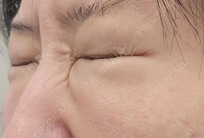 下まぶたの脂肪取り / 脂肪溶解注射（顔） 仙台N美容クリニック DAY 134 メイン用