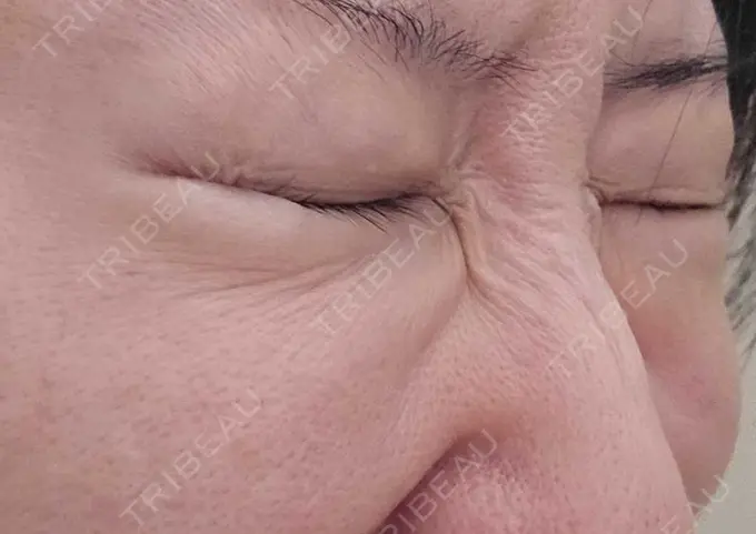 下まぶたの脂肪取り / 脂肪溶解注射（顔） 仙台N美容クリニック DAY 135 メイン用