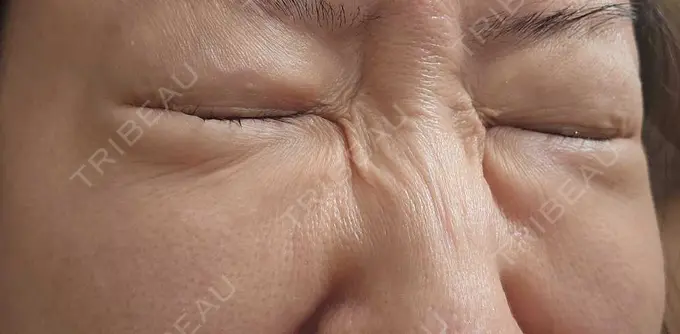 下まぶたの脂肪取り / 脂肪溶解注射（顔） 仙台N美容クリニック AFTER メイン用