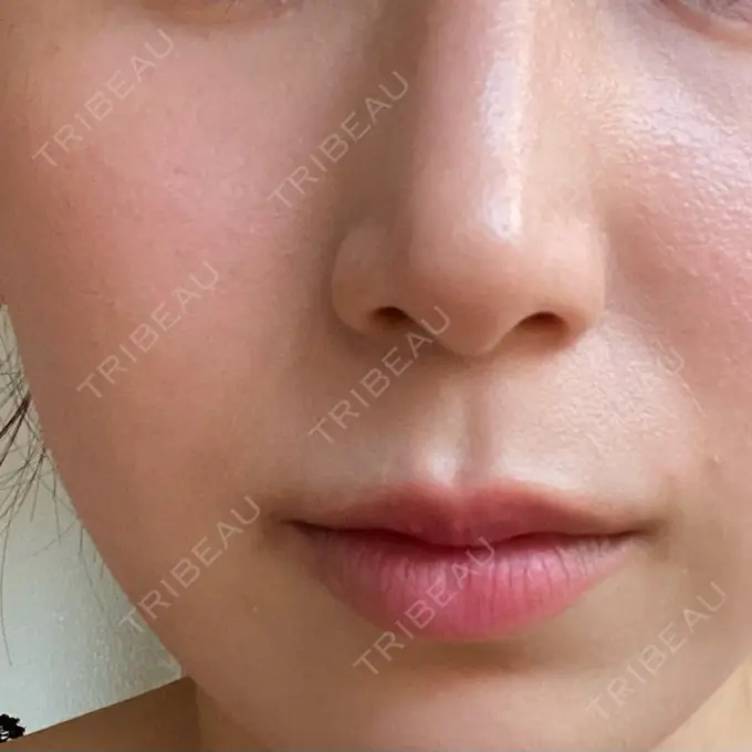 レーザートーニング（美白・肝斑） MAクリニック 心斎橋 AFTER メイン用