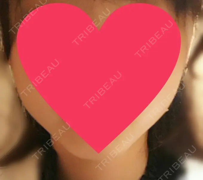 ハイフ（顔） 赤坂プレミアクリニック DAY 0 メイン用