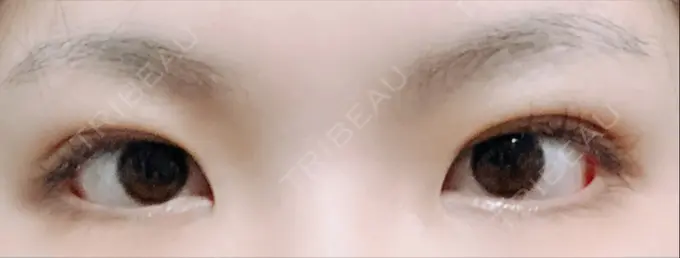 二重埋没 城本クリニック 福岡院 DAY 18 メイン用