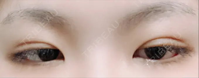 二重埋没 城本クリニック 福岡院 DAY 18 メイン用