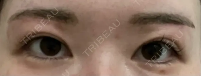 眉下切開 / ボトックス（眉間） / ボトックス（額） 銀座リシェスクリニック DAY 23 メイン用