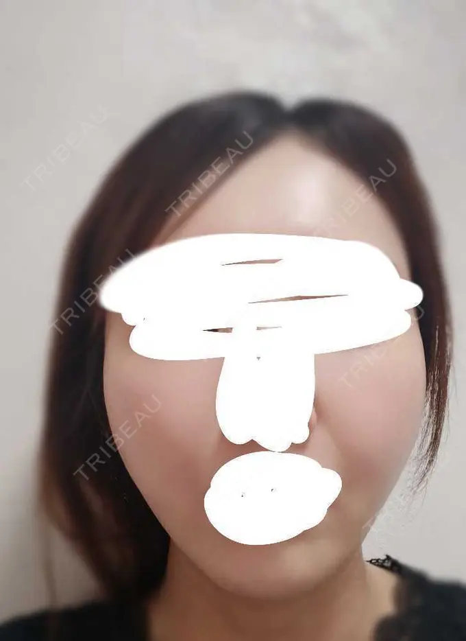 糸リフト アリエル美容クリニック 横浜院 DAY 7 メイン用