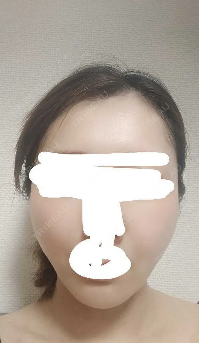 糸リフト アリエル美容クリニック 横浜院 DAY 14 メイン用