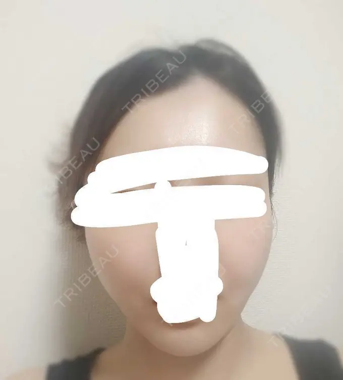 糸リフト アリエル美容クリニック 横浜院 AFTER メイン用