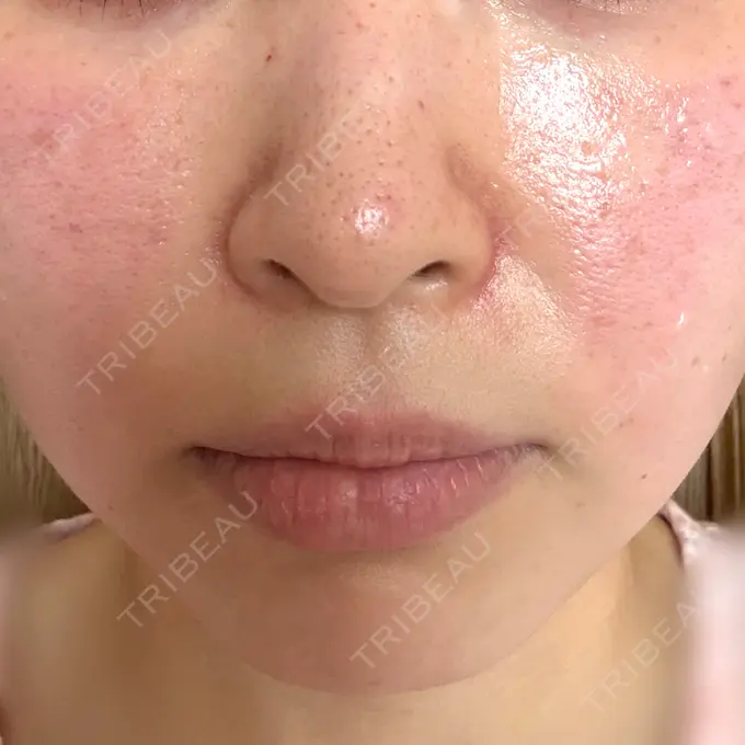 肌育注射（ジュベルックなど） 城本クリニック 姫路院 DAY 0 メイン用