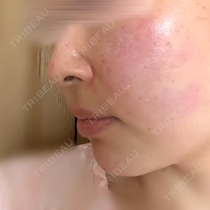 肌育注射（ジュベルックなど） 城本クリニック 姫路院 DAY 0 メイン用