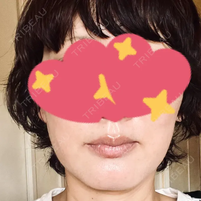 RF（高周波）たるみ治療 / その他（輪郭） DAILY SKIN CLINIC 心斎橋院 DAY 9 メイン用