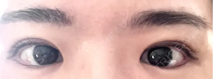 二重埋没 OMI CLINIC 【オミクリニック】 DAY 8 メイン用