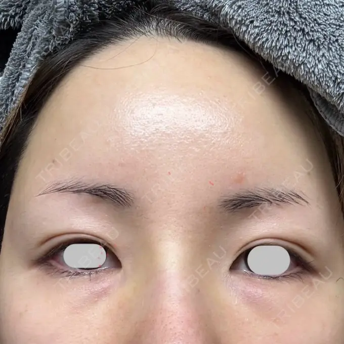 脂肪注入（額） / その他（輪郭） eクリニック 福岡院 DAY 14 メイン用