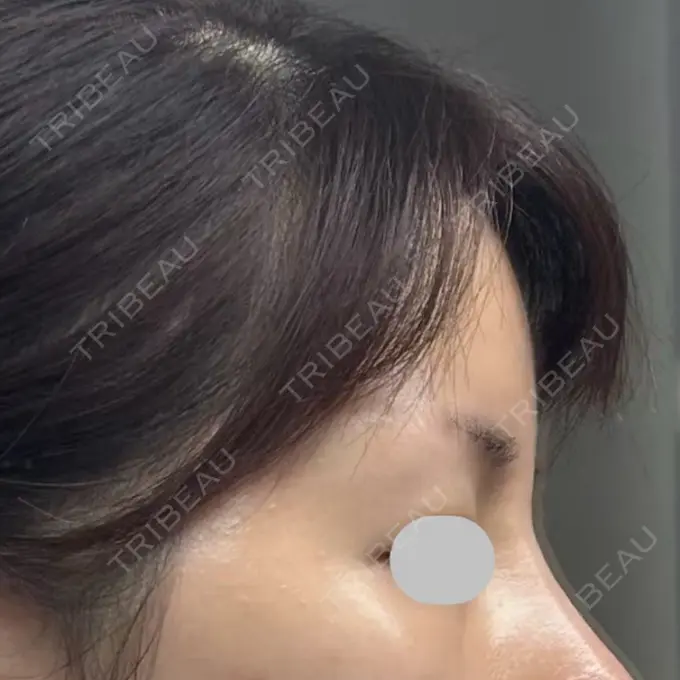 脂肪注入（額） / その他（輪郭） eクリニック 福岡院 DAY 30 メイン用