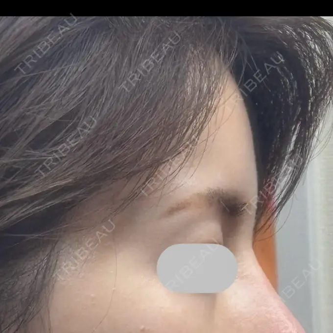 脂肪注入（額） / その他（輪郭） eクリニック 福岡院 DAY 60 メイン用