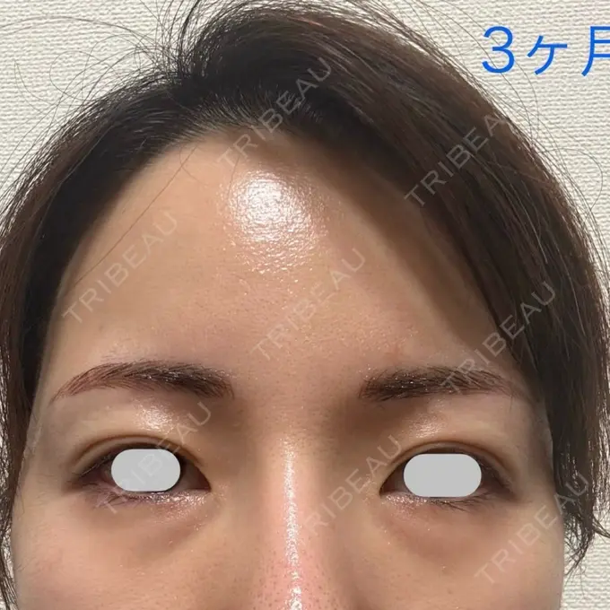 脂肪注入（額） / その他（輪郭） eクリニック 福岡院 AFTER メイン用