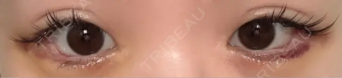 目尻切開 / タレ目形成・グラマラスライン（埋没） LOUIS CLINIC 二子玉川院【ルイクリニック】 DAY 4 メイン用