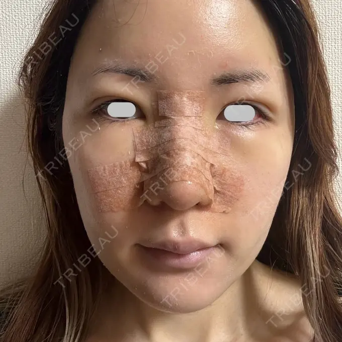 糸リフト / 脂肪吸引（顔） / ジョールファット除去 eクリニック 福岡院 DAY 7 メイン用