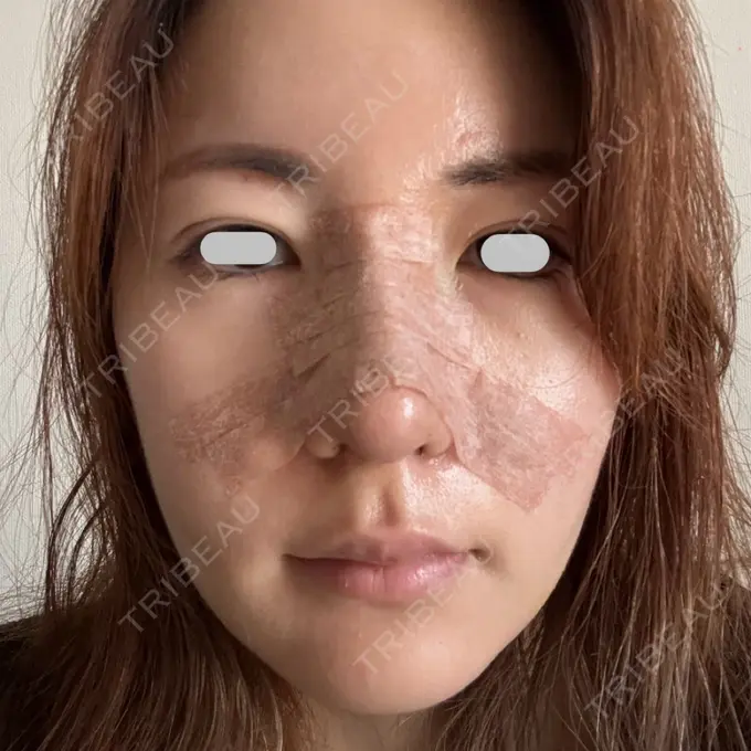 糸リフト / 脂肪吸引（顔） / ジョールファット除去 eクリニック 福岡院 DAY 8 メイン用