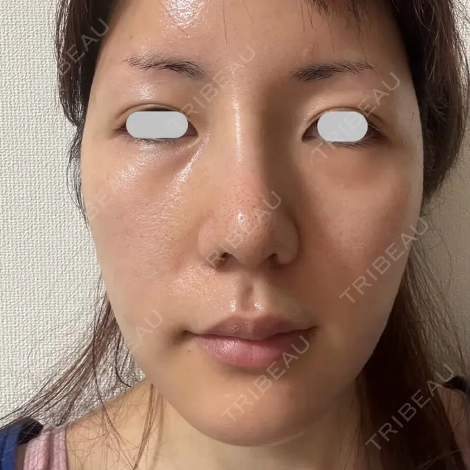 糸リフト / 脂肪吸引（顔） / ジョールファット除去 eクリニック 福岡院 DAY 30 メイン用