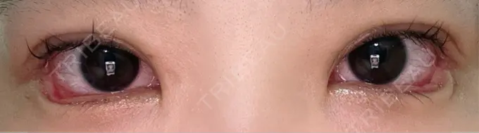 目尻切開 / タレ目形成・グラマラスライン（埋没） LOUIS CLINIC 二子玉川院【ルイクリニック】 DAY 2 メイン用