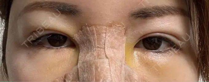 脂肪注入（目の下） eクリニック 福岡院 DAY 4 メイン用