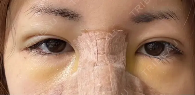 脂肪注入（目の下） eクリニック 福岡院 DAY 5 メイン用