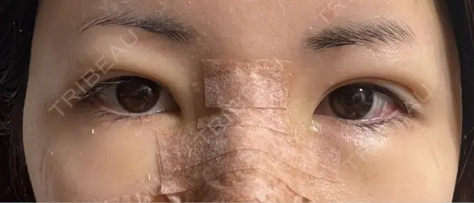 脂肪注入（目の下） eクリニック 福岡院 DAY 6 メイン用