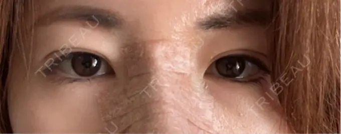 脂肪注入（目の下） eクリニック 福岡院 DAY 7 メイン用