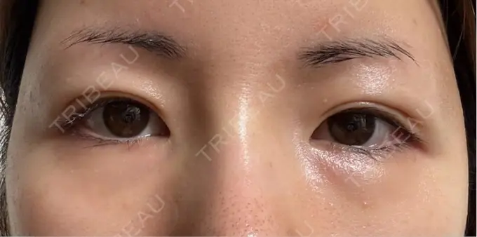 脂肪注入（目の下） eクリニック 福岡院 DAY 21 メイン用