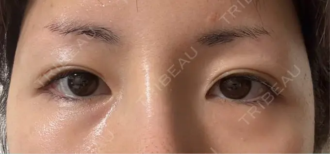 脂肪注入（目の下） eクリニック 福岡院 DAY 30 メイン用