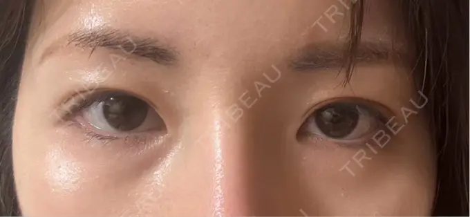 脂肪注入（目の下） eクリニック 福岡院 DAY 60 メイン用