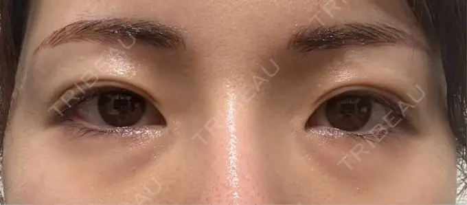 脂肪注入（目の下） eクリニック 福岡院 AFTER メイン用