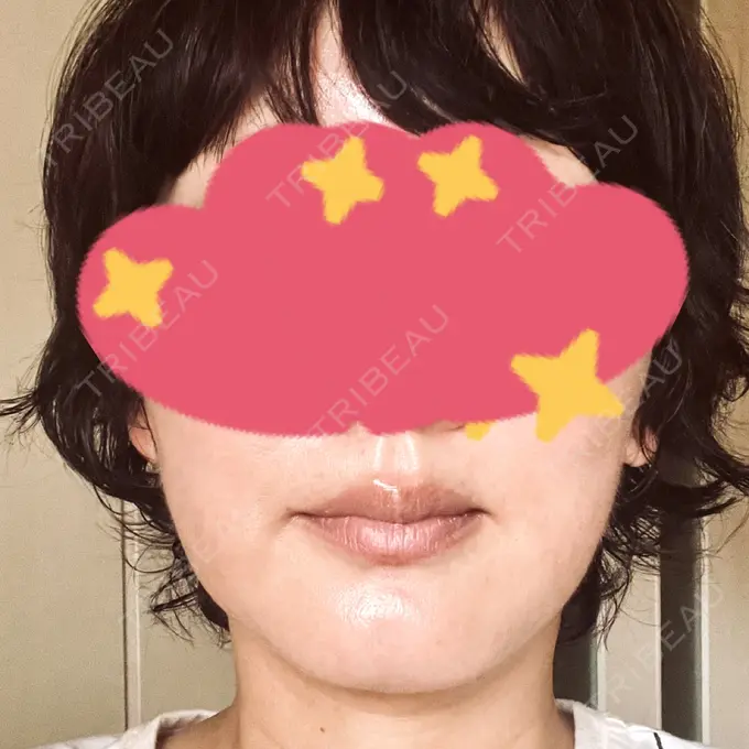 RF（高周波）たるみ治療 / その他（輪郭） DAILY SKIN CLINIC 心斎橋院 DAY 10 メイン用