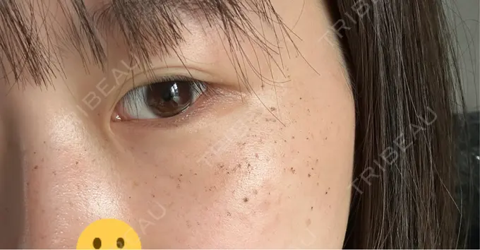 ルメッカ LIBER CLINIC DAY 4 メイン用