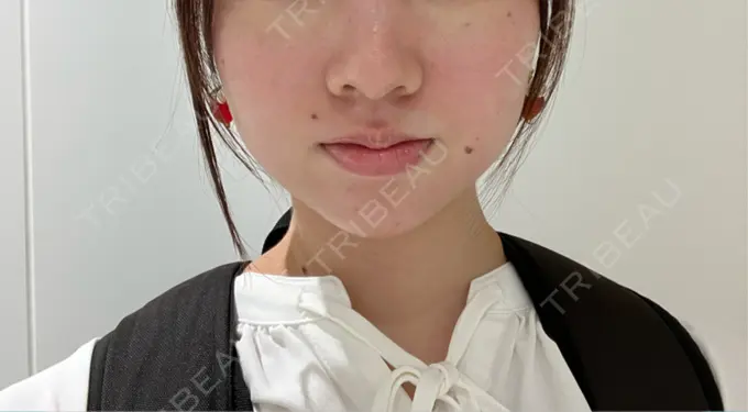 ヒアルロン酸注入（あご） / ボトックス（肩） HAAB BEAUTY CLINIC 名古屋院 DAY 4 メイン用