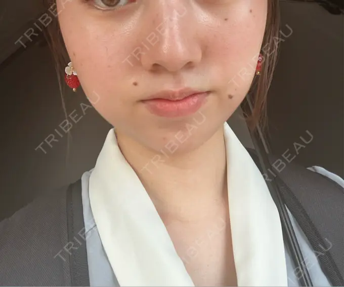 ヒアルロン酸注入（あご） / ボトックス（肩） HAAB BEAUTY CLINIC 名古屋院 DAY 5 メイン用