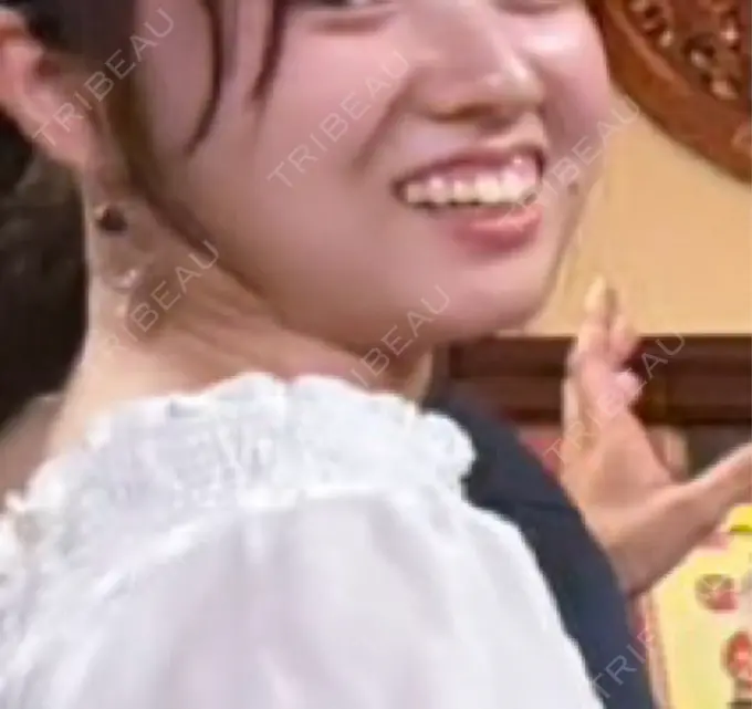 ヒアルロン酸注入（あご） / ボトックス（肩） HAAB BEAUTY CLINIC 名古屋院 DAY 15 メイン用