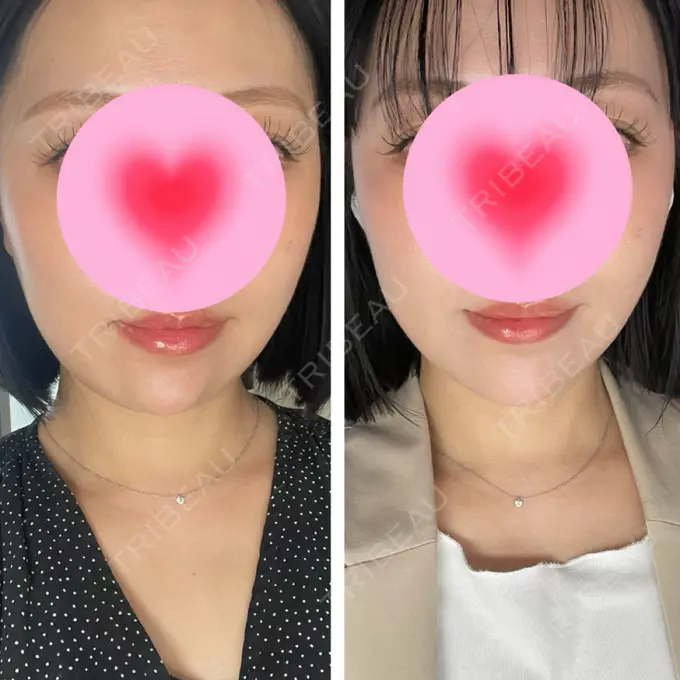 ボトックス（あご） / ボトックス（エラ・小顔） / ボトックス（口角） eクリニック 大阪院 AFTER メイン用